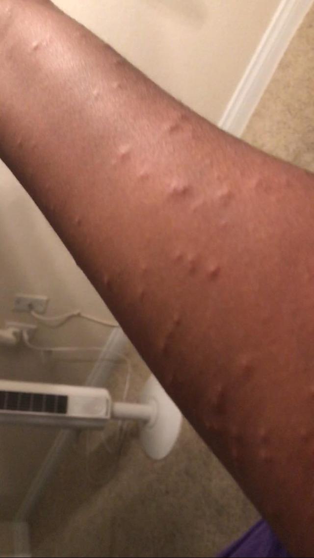 Skin irritation from Dove soap