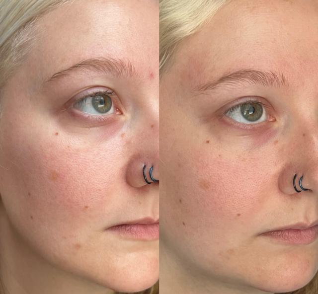 Before and After using Paula's Choice BHA Exfoliant