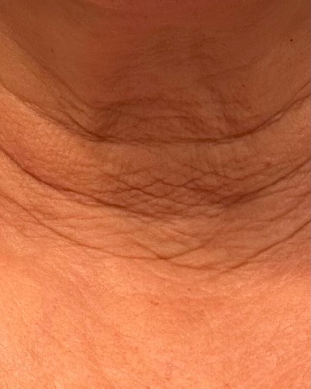 After using goPure Neck Firming Cream