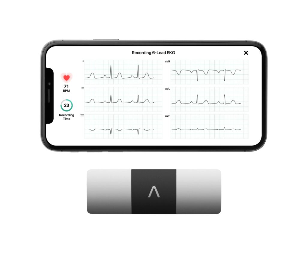 KardiaMobile 6-Lead Personal EKG Monitor – Six Views of The Heart – Detects AFib and Irregular Arrhythmias – Instant Results in 30 Seconds – Works with Most Smartphones - FSA/HSA Eligible